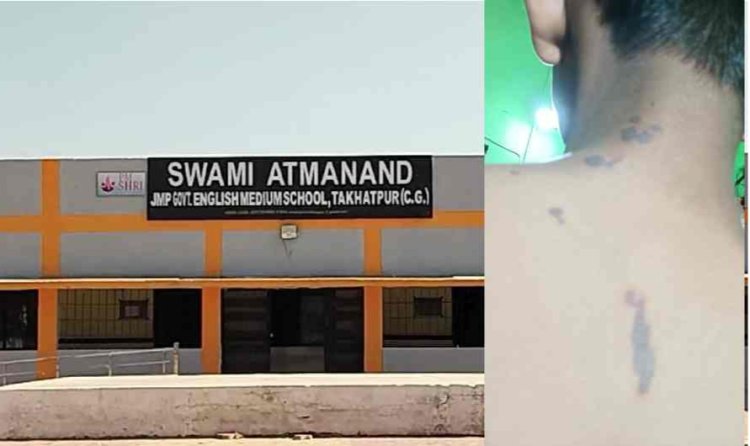 Chhattisgarh News : एसिड अटैक.! बुरी तरह झुलसा छात्र... स्कूल प्रबंधन की घोर लापरवाही...घायल बच्चे अस्पताल जे जाने के बजाय भेज दिया घर...पढ़ें पूरी खबर
