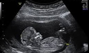 उच्च जोखिम वाली 1667 गर्भवती महिलाओं का किया गया नि:शुल्क सोनोग्राफी